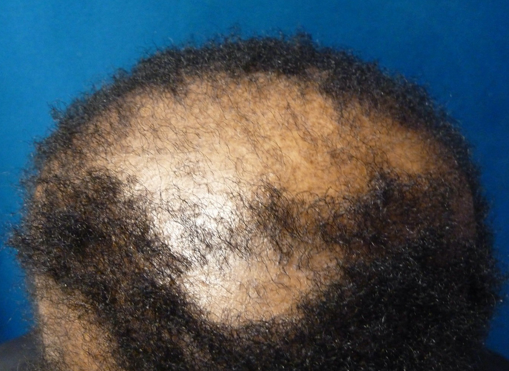 Figure 4: Central centrifugal cicatricial alopecia