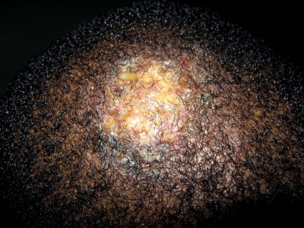 Figure 6: Kerion with secondary impetiginisation (skin infection)