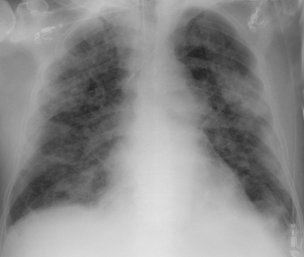 Figure: Example chest X-ray in patient with COVID-19 infection 