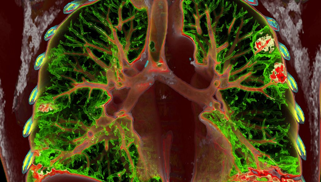 computer generated tomography scan of human lungs affected by COVID-19 pneumonia