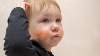 Photo of a toddler with eczema on their face
