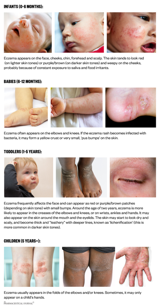 Managing childhood eczema: a visual guide - The Pharmaceutical Journal