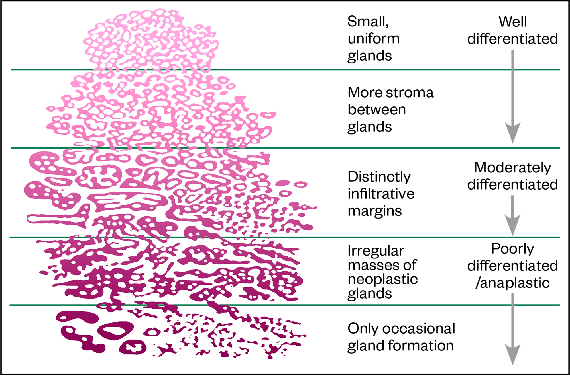 Figure: Gleason Pattern Scale