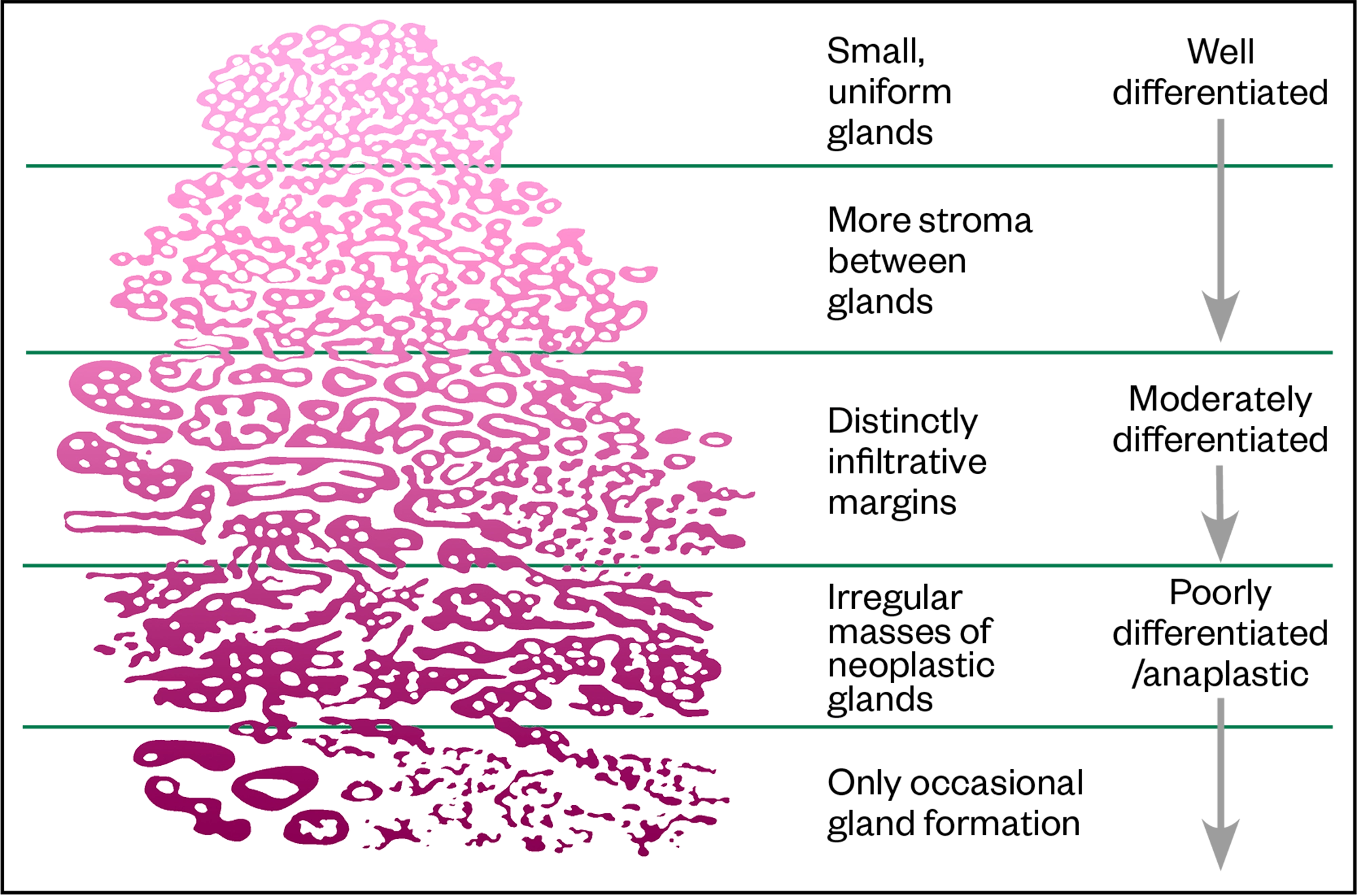 pathology of prostate cancer ncbi