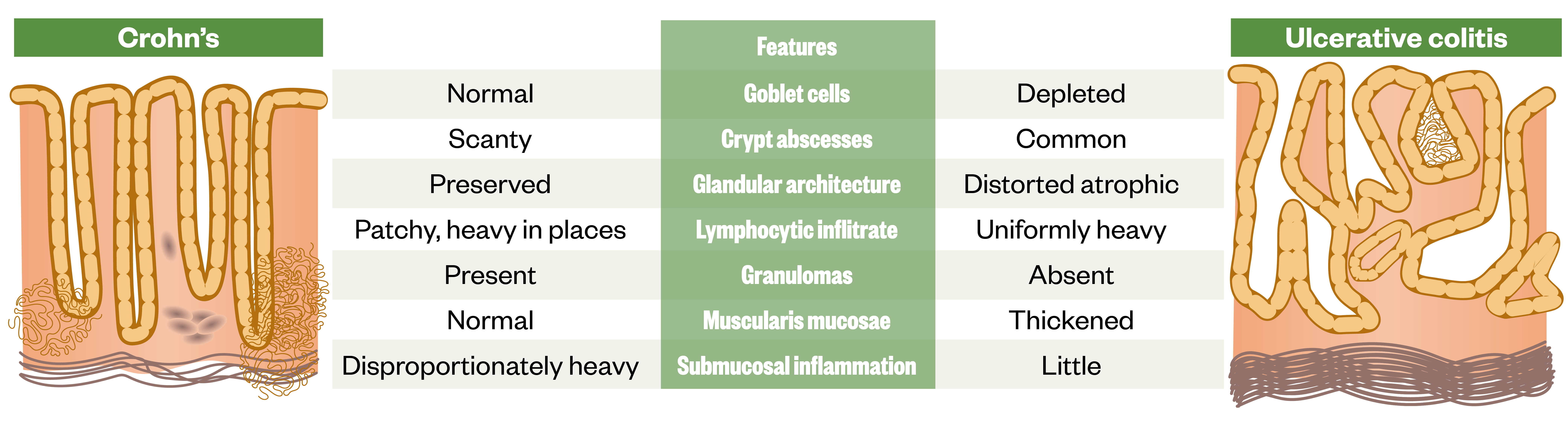 Figure 15: Histological differences between ulcerative colitis and Crohn's disease 