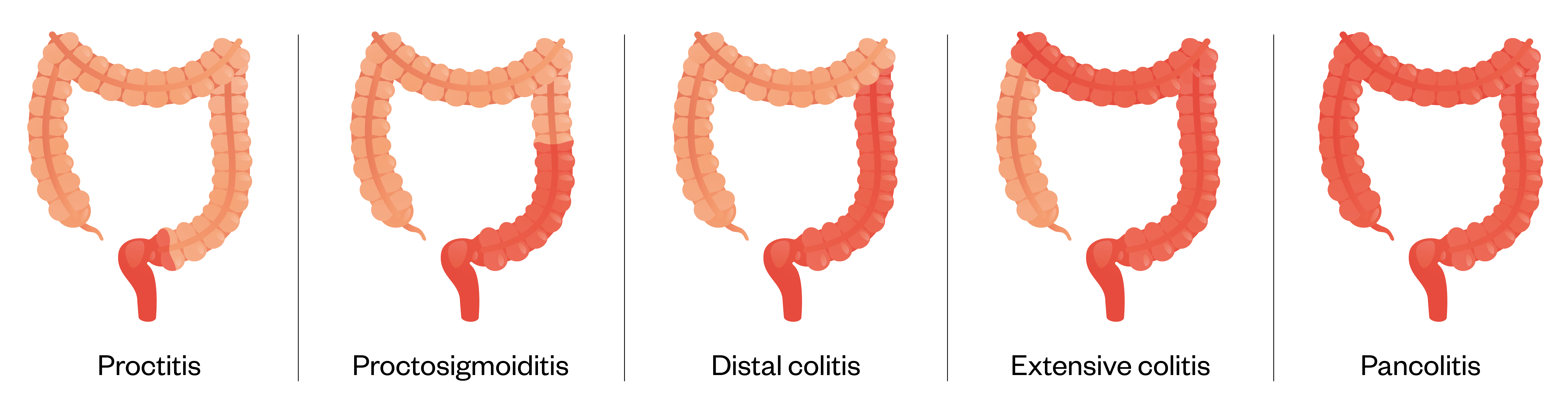Figure 2: Degree of inflammation in ulcerative colitis Source: Shutterstock.com