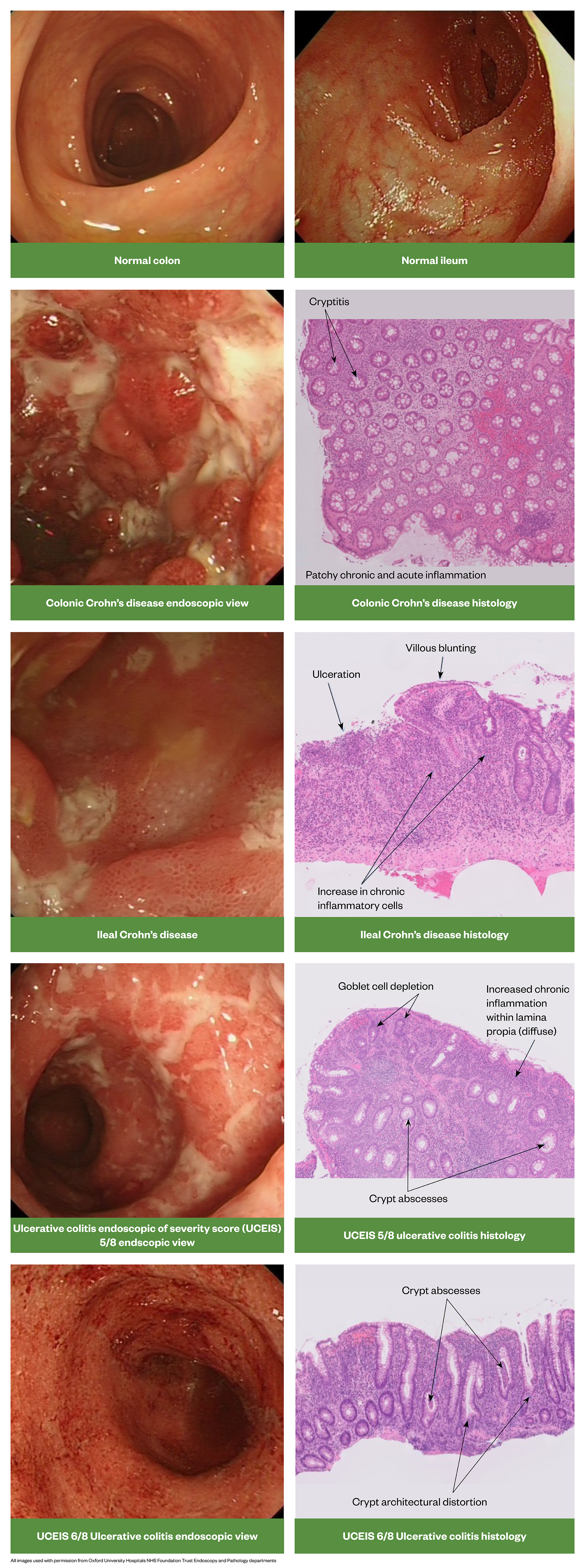 Figure 3–12: Endoscopic and histological views of Crohn's disease and ulcerative colitis