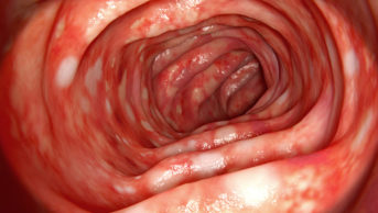 colon affected by ulcerative colitis