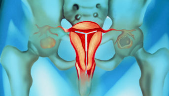 Illustrustration of an intrauterine device in the uterus