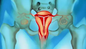 Illustrustration of an intrauterine device in the uterus