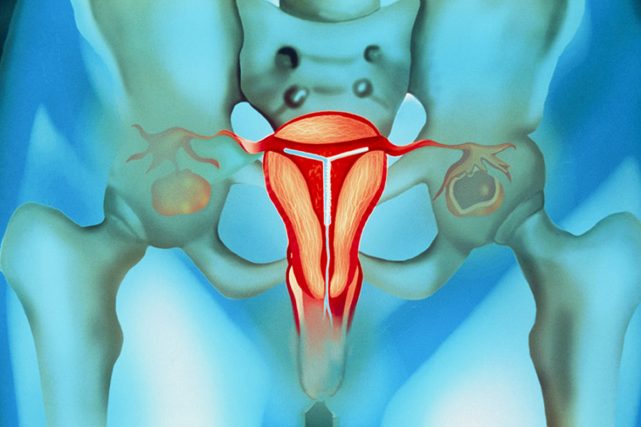 Illustrustration of an intrauterine device in the uterus