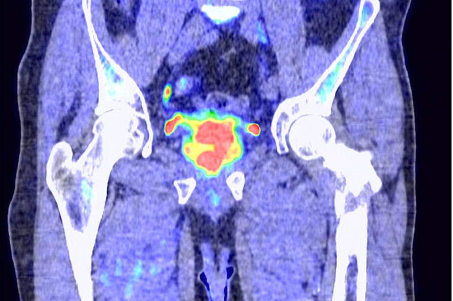 prostate cancer scan