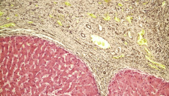 Case study: primary biliary cholangitis management with obeticholic acid