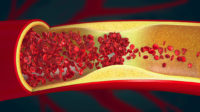 accumulation of blood cells in vein