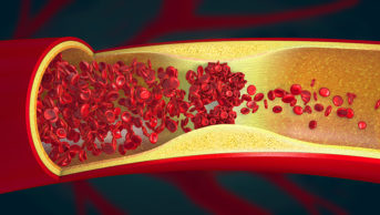 accumulation of blood cells in vein