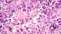 Micrograph of non small cell lung carcinoma