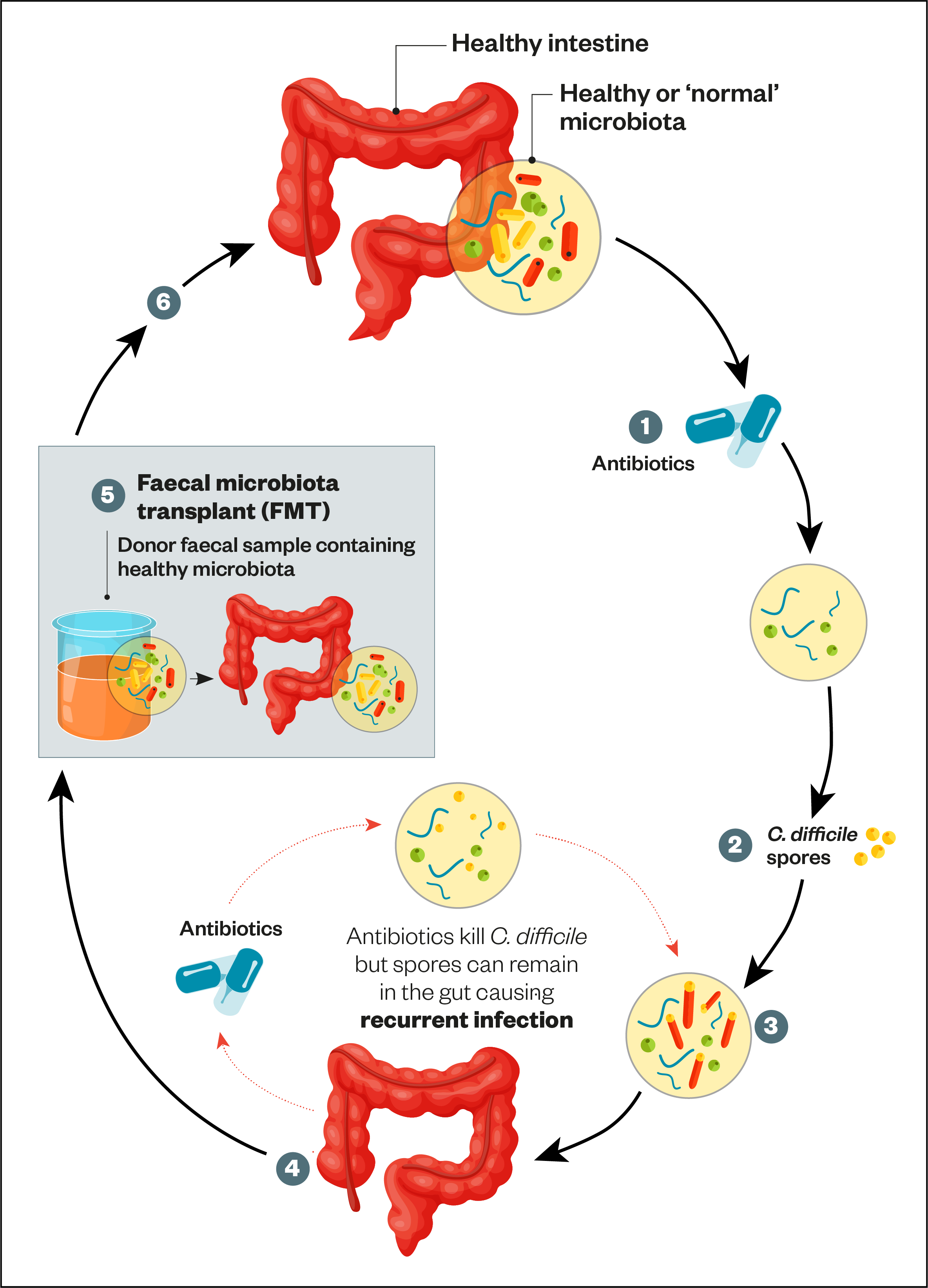 Figure: The role of faecal microbiota transplantation in Clostridioides difficile infection     