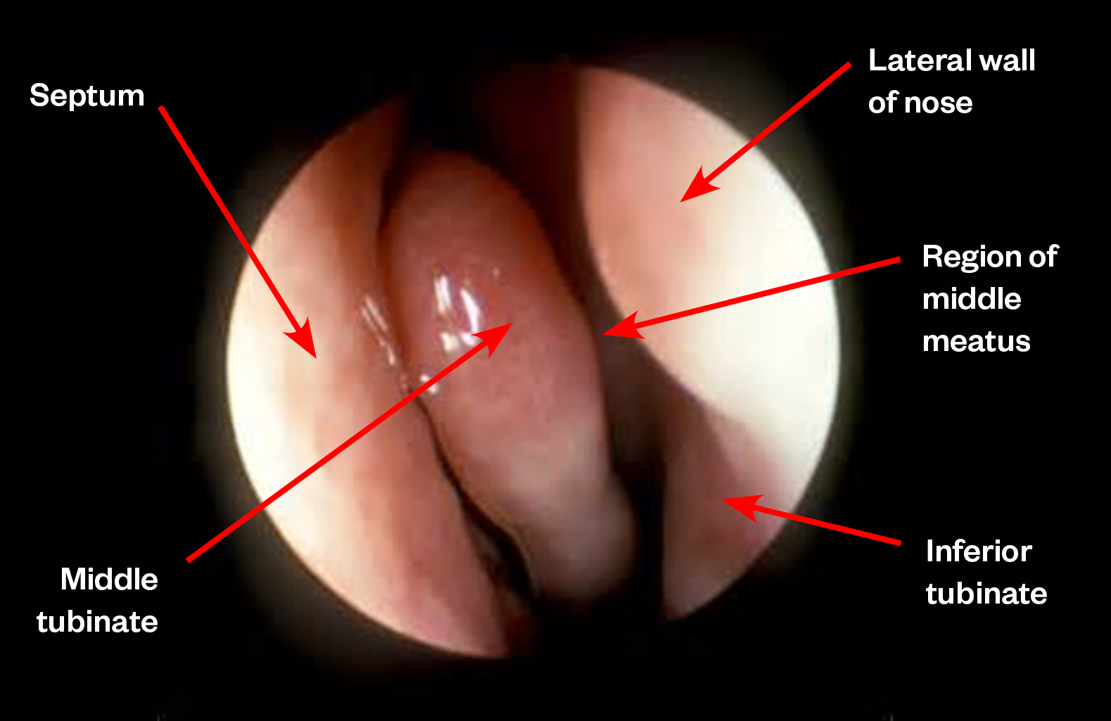Figure 2- Endoscopic photograph of inside the left nasal cavity