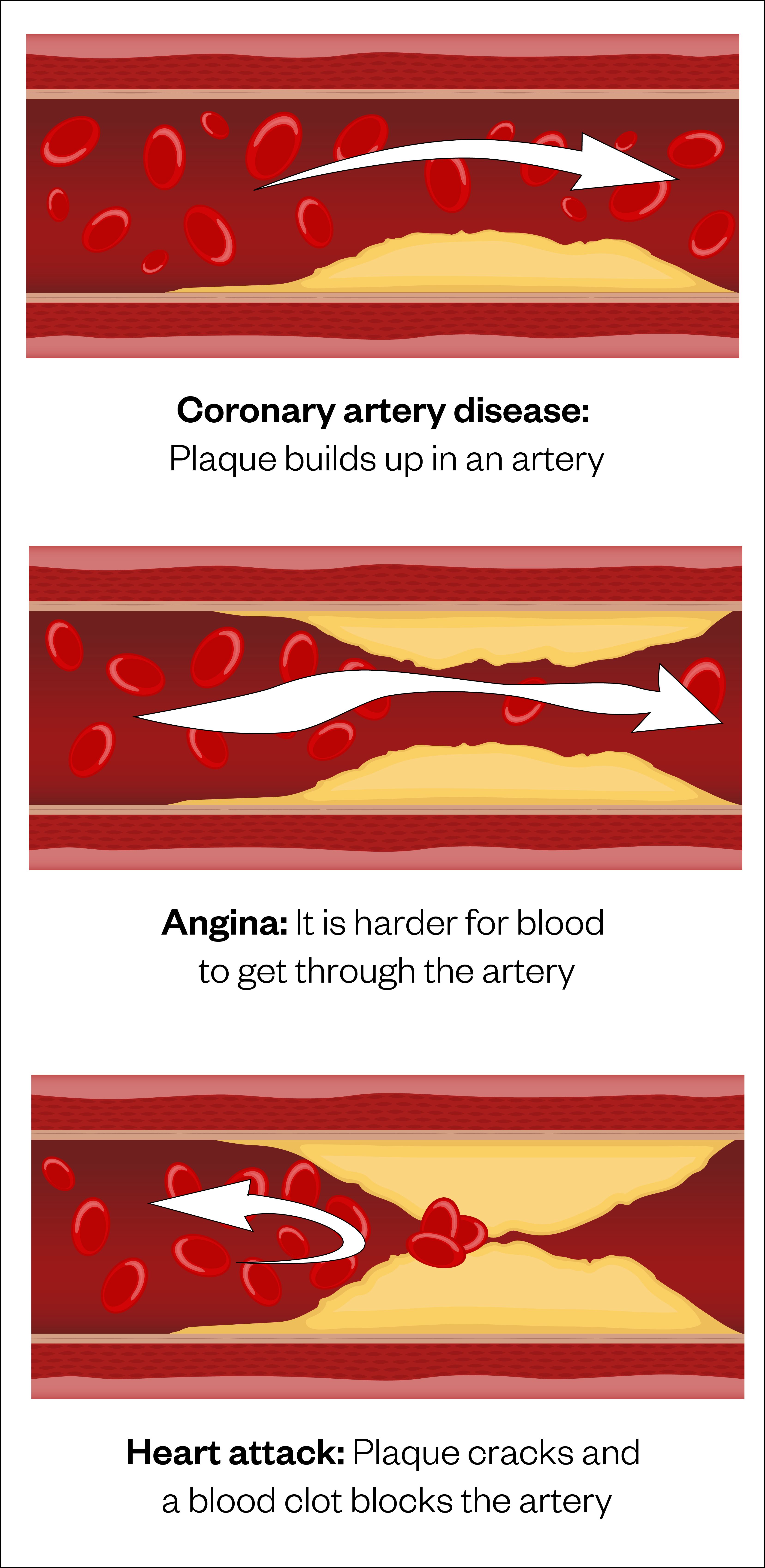 Figure 1: The process of coronary artery disease, angina and heart attack