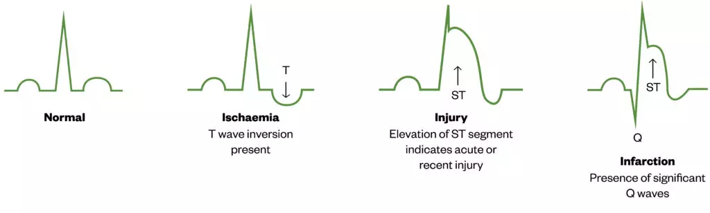 Diagnosis and management of stable angina - The Pharmaceutical Journal