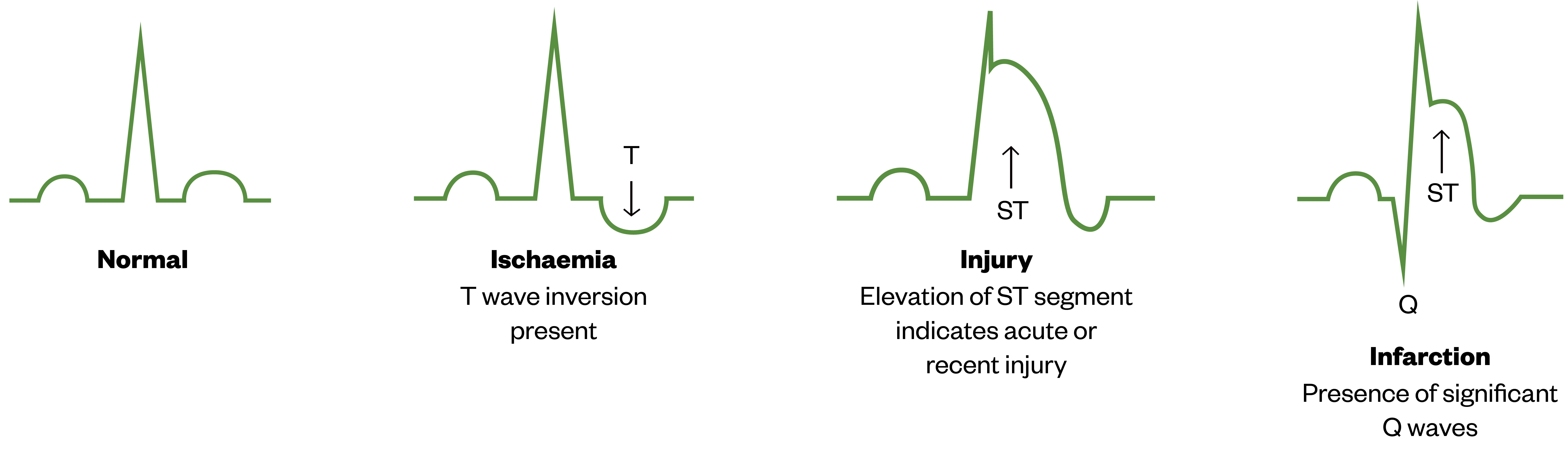 Figure 2: A simplified diagram illustrating expected ECG changes in myocardial ischaemia, injury and infarction