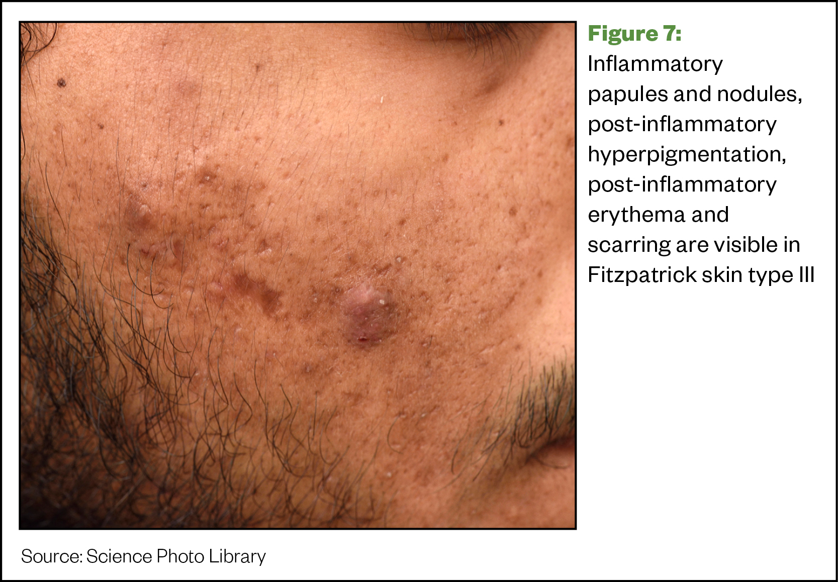 Inflammatory papules and nodules, post-inflammatory hyperpigmentation, post-inflammatory erythema and scarring 