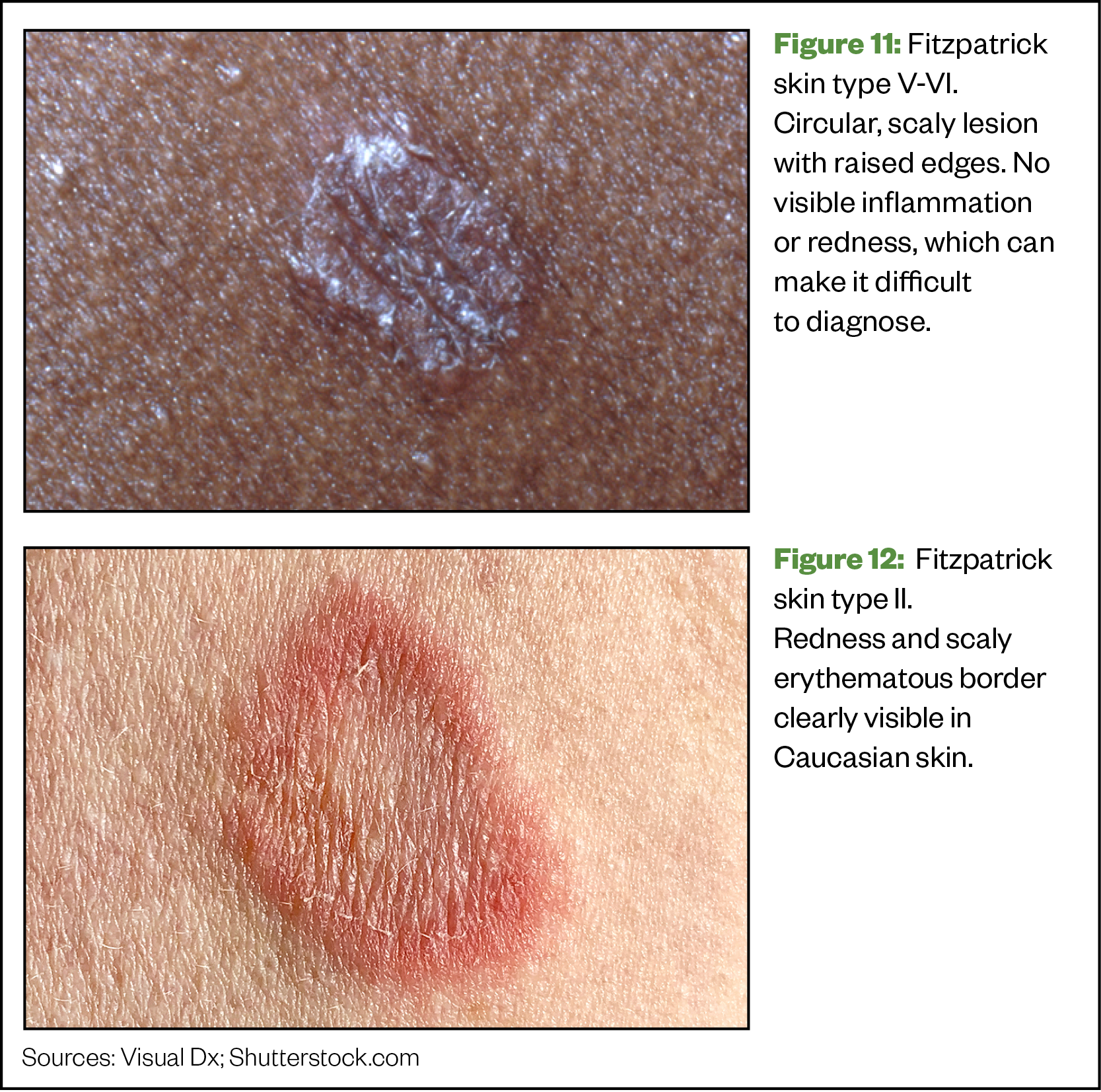 Figure 11: Fitzpatrick skin type V-VI. Circular, scaly lesion with raised edges. Figure 12:  Fitzpatrick skin type II. Redness and scaly erythematous border 