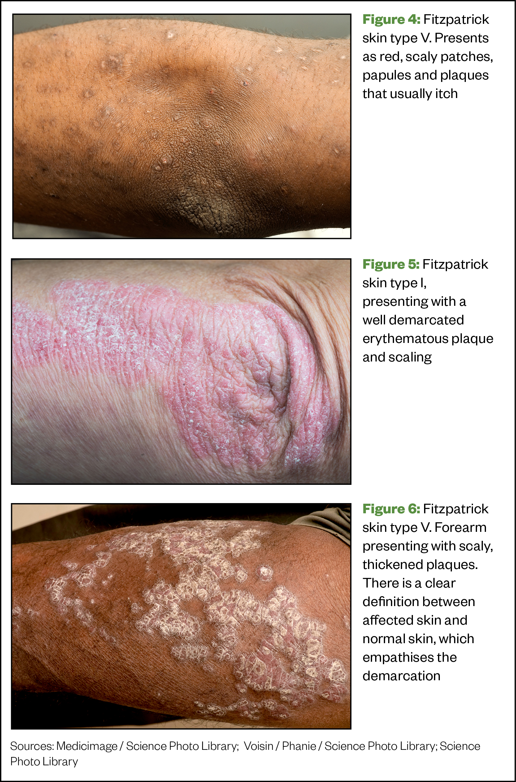 Figure 4: Scaly patches, papules and plaques that usually itch. Figure 5: well demarcated erythematous plaque and scaling. Figure 6:  Forearm presenting with scaly, thickened plaques. 