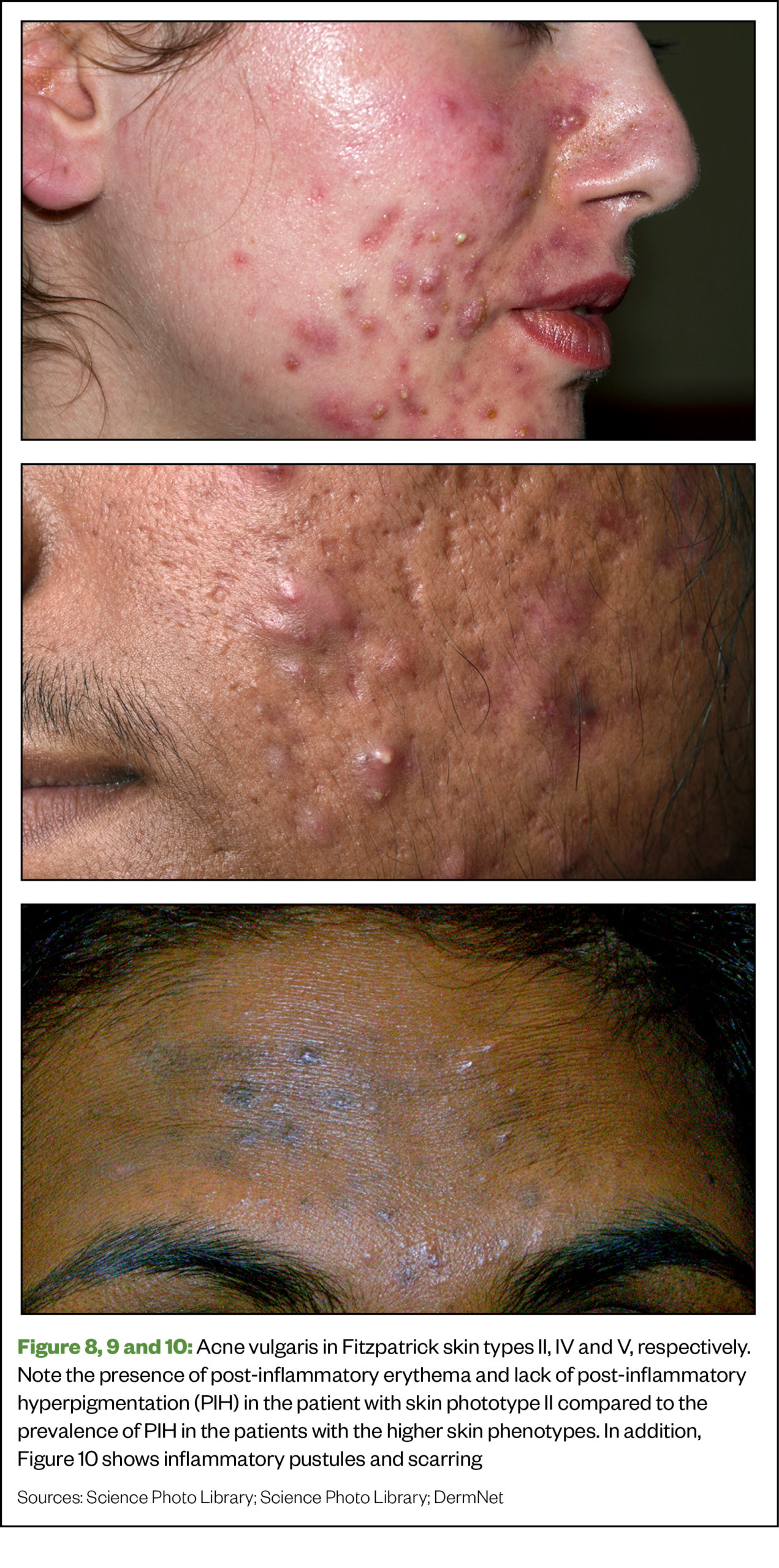 Figure 8, 9 and 10: Acne vulgaris in Fitzpatrick skin types II, IV and V