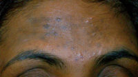 inflammatory pustules and scarring
