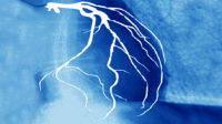 Angiogram of a narrowed heart artery