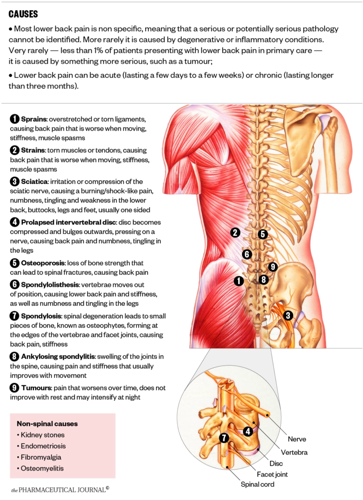 Getting back on track: management of lower back pain - The ...