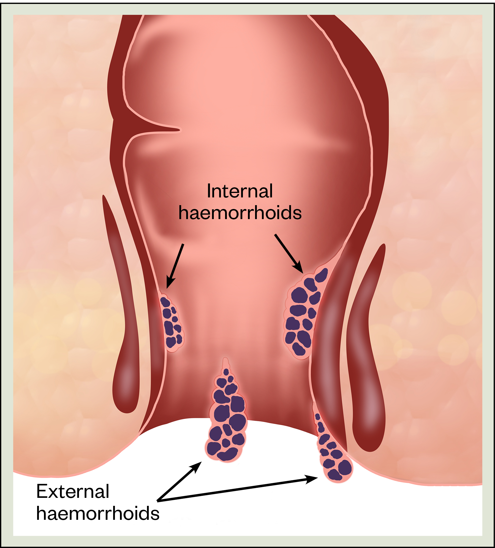 Figure 1: Types of haemorrhoid