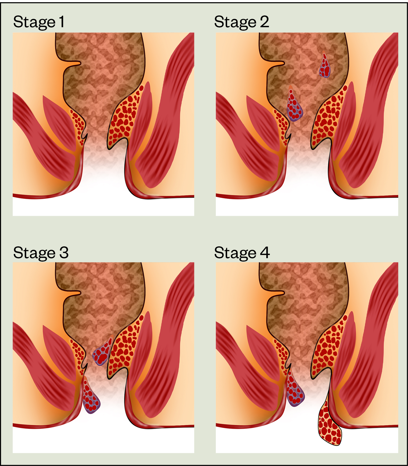 Figure 2: Goligher staging of haemorrhoids