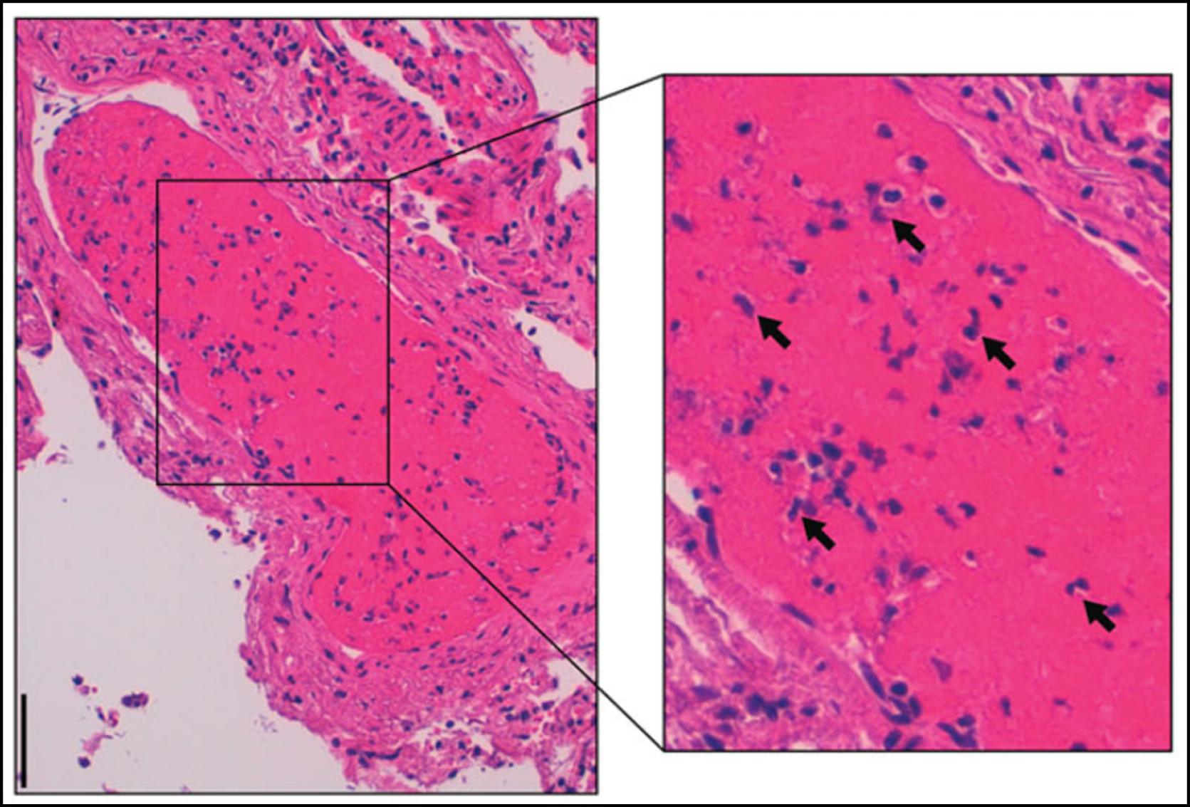 Figure 2: Hematoxylin-eosin staining of a pulmonary immunothrombus in a COVID-19 patient. Immune cells, most notably cells with segmented nuclei, can be observed in the thrombus (black arrows)