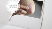 Picture of finger pointing to plaque psoriasis on the elbow in a file folder