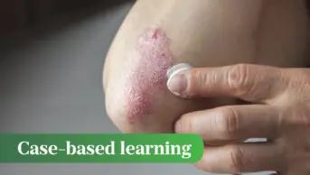Psoriasis on elbow