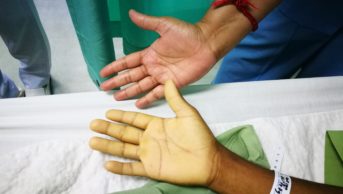Hands showing severe anemia due to blood loss