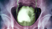 Bladder cancer. Coloured X-ray of a large cancerous tumour