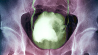 Bladder cancer. Coloured X-ray of a large cancerous tumour