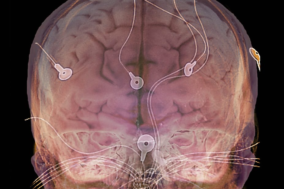 Electrodes on an epileptic patient's head monitoring the brain's electrical activity and producing an electroencephalogram