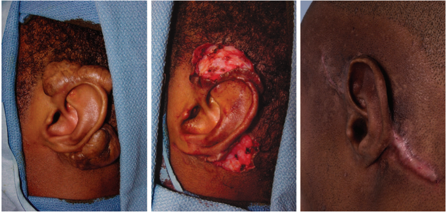 Figure 7: Surgical excision of a large keloid around the left ear: preoperatively (left); after surgical excision (center); and postoperatively after primary closure (right)