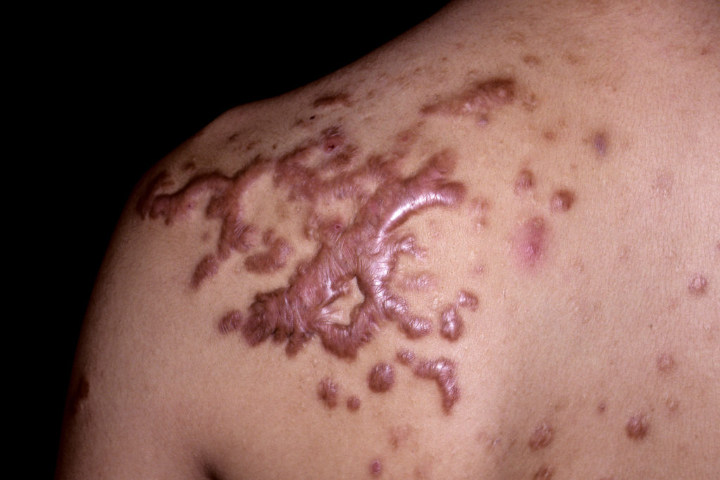 Keloid scars: recognition and management - The Pharmaceutical Journal