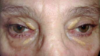 Close-up of xanthelasma on the eyelids of a 70-year-old female patient.