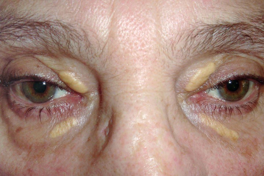 Close-up of xanthelasma on the eyelids of a 70-year-old female patient.