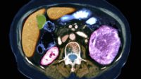Coloured axial CT scan through the abdomen of a 59-year-old man with cancer of his left kidney (enlarged at right, pink)
