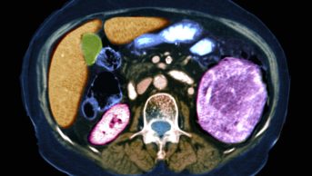 Coloured axial CT scan through the abdomen of a 59-year-old man with cancer of his left kidney (enlarged at right, pink)