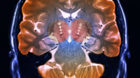 MRI brain scan of patient with Parkinson's disease