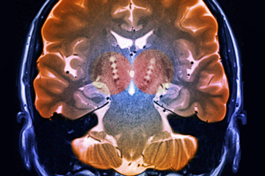 MRI brain scan of patient with Parkinson's disease