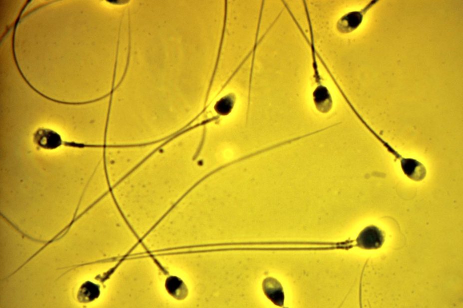 LM of human sperm, showing one with two tails